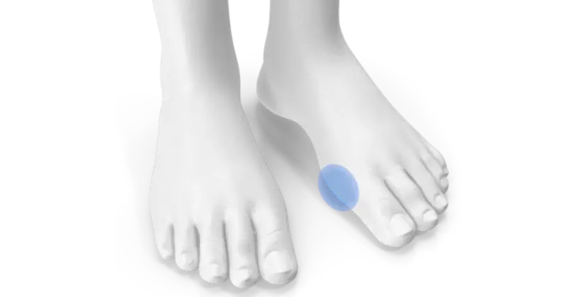 hallux valgus