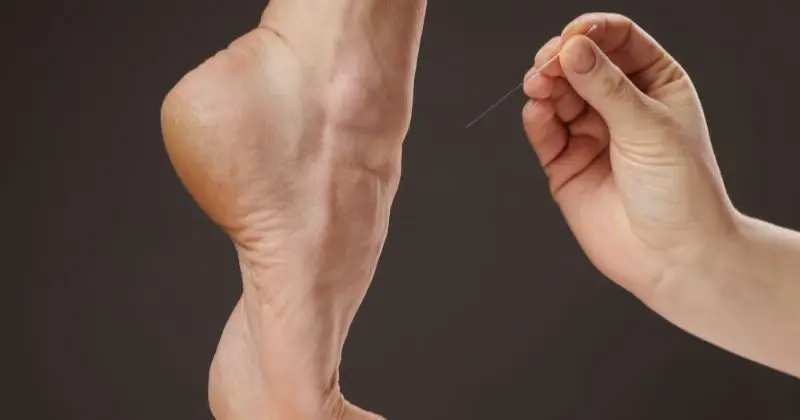 Alcoolização do neuroma de Morton