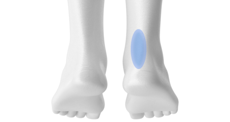 Entesopatia Una Guida Completa SmartHallux 