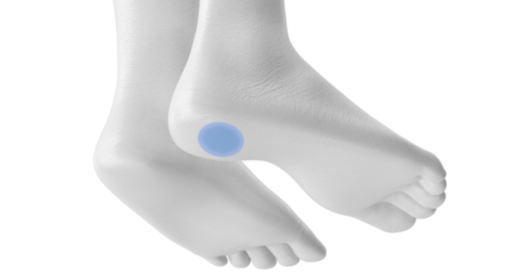 Spina calcaneare