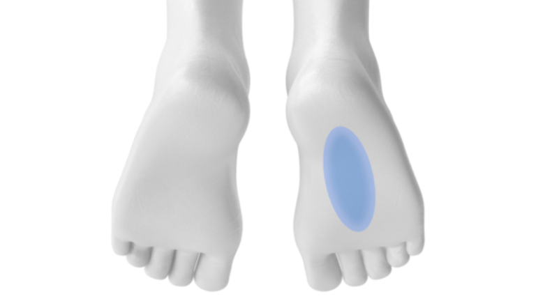 fasciotomia plantare