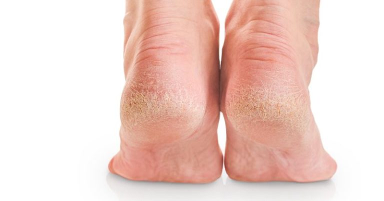 Ipercheratosi Tallone