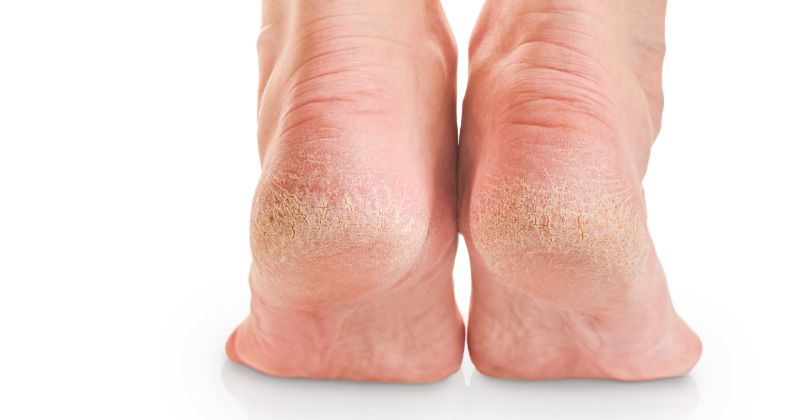 Ipercheratosi Tallone