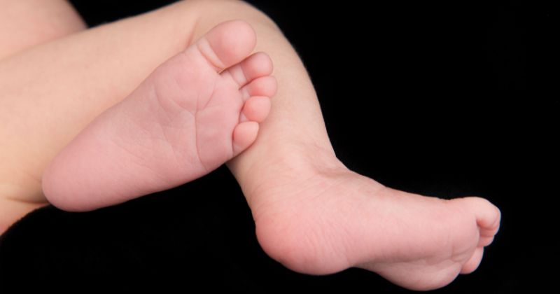 piede torto congenito