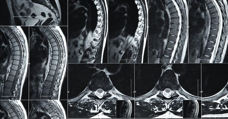 Neurinoma Toracico