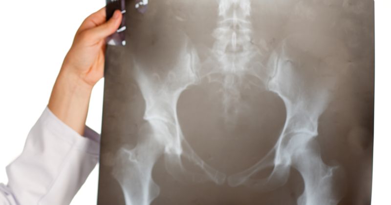 calcificazione anca
